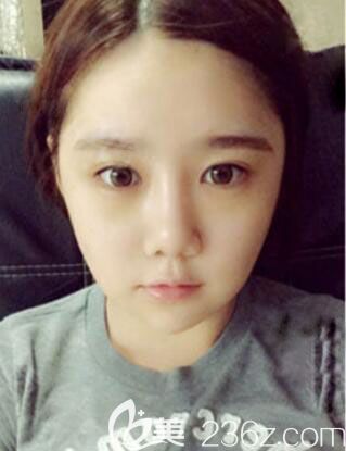 韩国ID整形医院自体脂肪面部填充+V脸提升案例术后效果图 韩国ID整形医院自体脂肪面部填充+V脸提升案例术后效果图