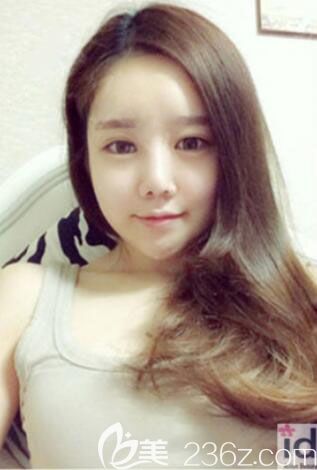 韩国id整形医院面部轮廓整形真人案例恢复过程 韩国id整形医院面部轮廓整形真人案例恢复过程