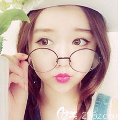 韩国id整形医院好不好?纳米脂肪移植+面部提升+颧骨降低案例术后效果 韩国id整形医院好不好?纳米脂肪移植+面部提升+颧骨降低案例术后效果