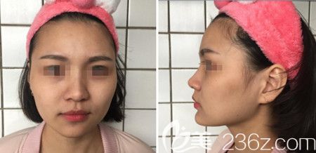 韩国佳轮韩做颧骨整形+面部吸脂手术前 韩国佳轮韩做颧骨整形+面部吸脂手术前