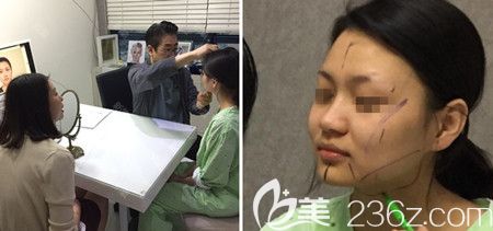 韩国佳轮韩做颧骨整形+面部吸脂手术当天设计 韩国佳轮韩做颧骨整形+面部吸脂手术当天设计