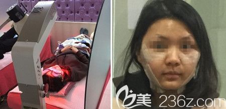 韩国佳轮韩做颧骨整形+面部吸脂手术后4天 韩国佳轮韩做颧骨整形+面部吸脂手术后4天