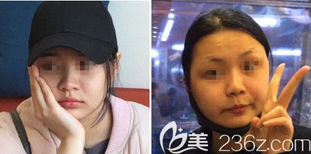 韩国佳轮韩做颧骨整形+面部吸脂手术后9天 韩国佳轮韩做颧骨整形+面部吸脂手术后9天