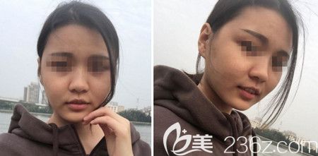 韩国佳轮韩做颧骨整形+面部吸脂手术后1个月 韩国佳轮韩做颧骨整形+面部吸脂手术后1个月