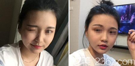 韩国佳轮韩做颧骨整形+面部吸脂手术后3个月 韩国佳轮韩做颧骨整形+面部吸脂手术后3个月