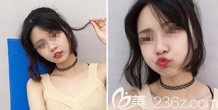 在韩国佳轮韩做颧骨颧弓+面部吸脂手术后半年发现自己之前的大饼脸真不好看