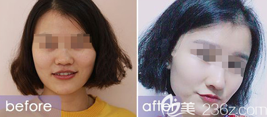 威海鼻综合案例二