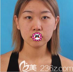 在北京美莱做膨体隆鼻和双眼皮前样子 在北京美莱做膨体隆鼻和双眼皮前样子