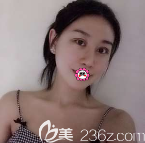 在北京美莱做膨体隆鼻和切开双眼皮第9天样子 在北京美莱做膨体隆鼻和切开双眼皮第9天样子