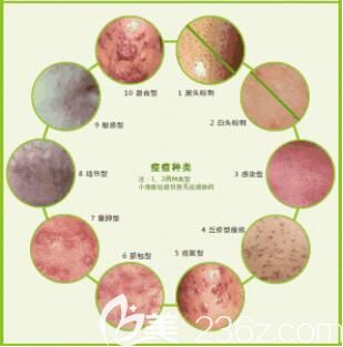 红蓝光祛痘类型
