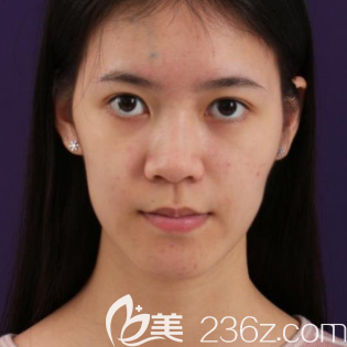 去东莞美立方做脂肪填充前的样子 去东莞美立方做脂肪填充前的样子