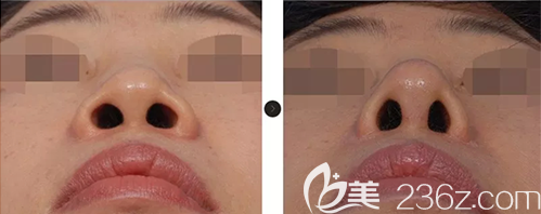 韩国韩娜鼻整形医院假体隆鼻综合整形案例前后效果对比图 韩国韩娜鼻整形医院假体隆鼻综合整形案例前后效果对比图