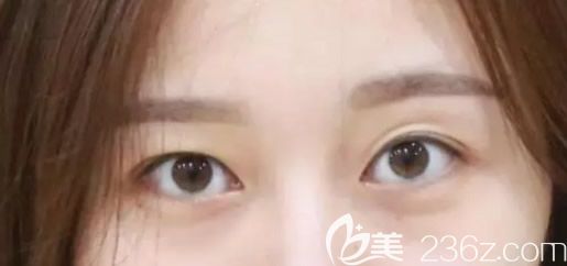 包头叶子整形医院割双眼皮前 包头叶子整形医院割双眼皮前