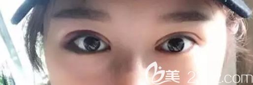 包头叶子<!--<i data=20240703-sp></i>-->韩式三点双眼皮第五天效果 包头叶子<!--<i data=20240703-sp></i>-->韩式三点双眼皮第五天效果