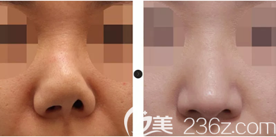 韩国韩娜鼻整形医院假体隆鼻失败修复案例 韩国韩娜鼻整形医院假体隆鼻失败修复案例