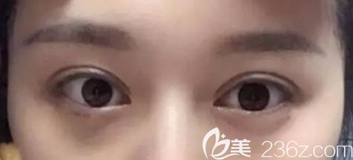 <!--<i data=20240703-sp></i>-->割双眼皮第十天恢复图 <!--<i data=20240703-sp></i>-->割双眼皮第十天恢复图