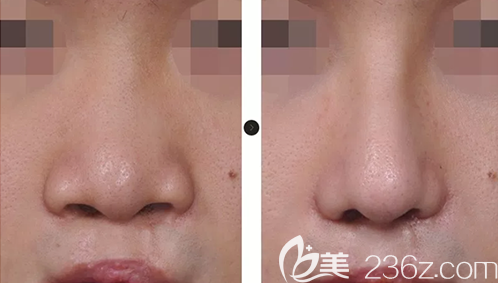 韩国韩娜鼻整形医院张槿旭院长隆鼻案例效果图