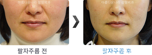 韩国吴金斯整形医院埋线提升手术案例 韩国吴金斯整形医院埋线提升手术案例
