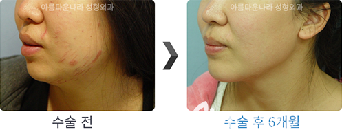 韩国吴金斯整形医院面部吸脂手术对比案例 韩国吴金斯整形医院面部吸脂手术对比案例