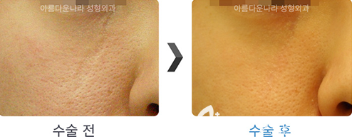 韩国吴金斯整形外科面部祛疤手术对比案例 韩国吴金斯整形外科面部祛疤手术对比案例