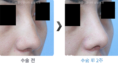 韩国吴金斯整形外科鹰钩鼻矫正术前后照片对比图 韩国吴金斯整形外科鹰钩鼻矫正术前后照片对比图