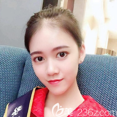 全脸自体脂肪面部填充术后12天恢复照片 全脸自体脂肪面部填充术后12天恢复照片