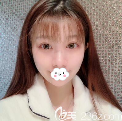 成都向朝双眼皮术后20天恢复效果图