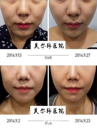 韩国美尔韩面部提升案例 韩国美尔韩面部提升案例
