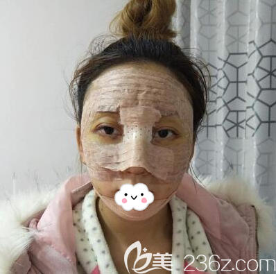 隆鼻丰下巴+面部脂肪填充术后即刻