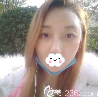 向朝肋软骨隆鼻+自体脂肪全面部填充拆线后效果