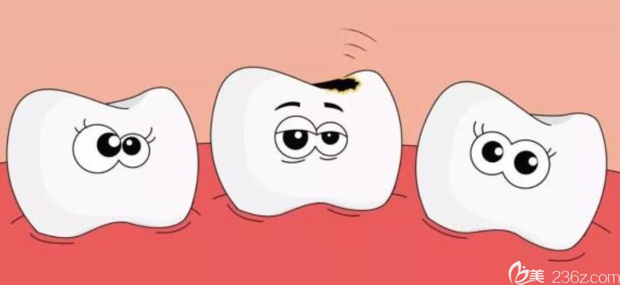 曾燕晓医生科普:幼儿龋齿有没有必要补牙 曾燕晓医生科普:幼儿龋齿有没有必要补牙