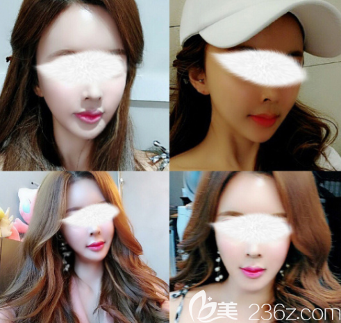 韩国博朗温颧骨旋转术+ 自体软骨垫鼻基底真人案例