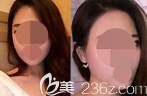 韩国博朗做轮廓怎么样