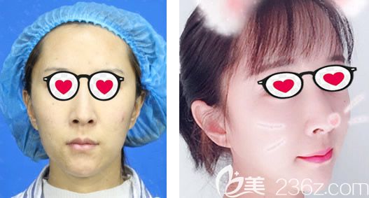 呼和浩特京美吕广旭全脸脂肪填充效果怎么样