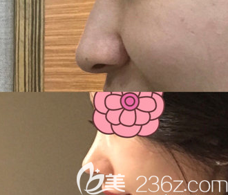 金贵洛隆鼻真人案例 金贵洛隆鼻真人案例