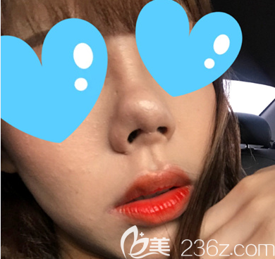 韩国博朗温做鼻子怎么样 韩国博朗温做鼻子怎么样