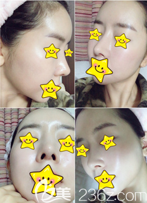 金贵洛鼻整形真人案例 金贵洛鼻整形真人案例