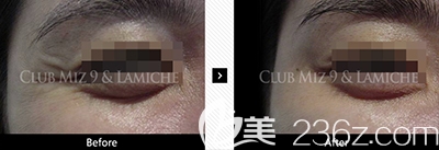 韩国注射瘦脸除皱祛皱案例