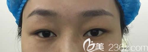 给大家看看我没在吉安天使整形做仿生无痕双眼皮前的照片 给大家看看我没在吉安天使整形做仿生无痕双眼皮前的照片