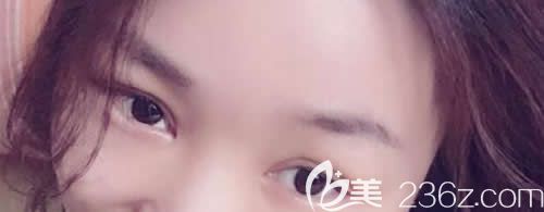 我在吉安天使整形做仿生无痕双眼皮术后第6天效果 我在吉安天使整形做仿生无痕双眼皮术后第6天效果