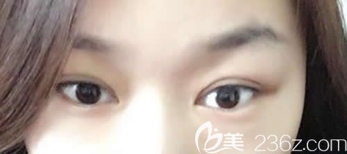 吉安天使整形袁宝玉院长给我做仿生无痕双眼皮术后第18天恢复效果 吉安天使整形袁宝玉院长给我做仿生无痕双眼皮术后第18天恢复效果