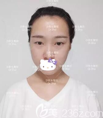 在大连沙医生整形医院做双眼皮眼综合术前照 在大连沙医生整形医院做双眼皮眼综合术前照