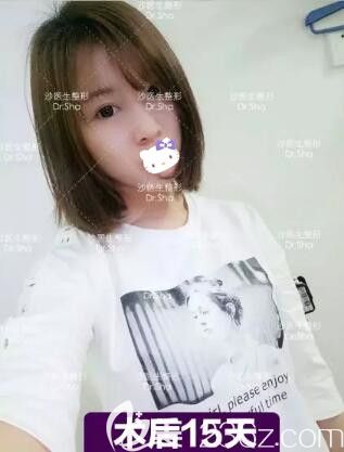 在大连沙医生整形做完眼综合术后半个月效果 在大连沙医生整形做完眼综合术后半个月效果