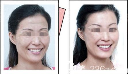 雅芳亚激光除皱案例 雅芳亚激光除皱案例