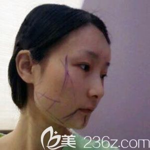 韩国佳轮韩整形医院轮廓三件套真人案例 韩国佳轮韩整形医院轮廓三件套真人案例