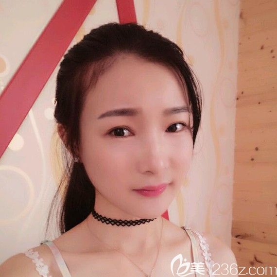 韩国佳轮韩下颌角+下巴+颧骨整形手术案例下颌角+下巴+颧骨整形案例术后效果图 韩国佳轮韩下颌角+下巴+颧骨整形手术案例下颌角+下巴+颧骨整形案例术后效果图