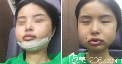 在韩国绮林做轮廓手术+面部脂肪填充手术后3天
