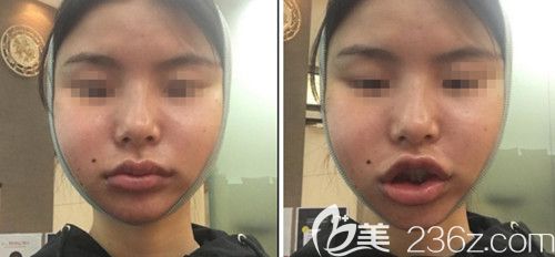 在韩国绮林做轮廓手术+面部脂肪填充手术后5天