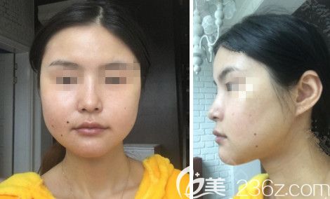 在韩国绮林做轮廓手术+面部脂肪填充手术后7天