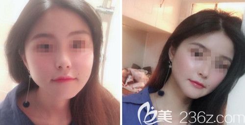 在韩国绮林做轮廓手术+面部脂肪填充手术后20天